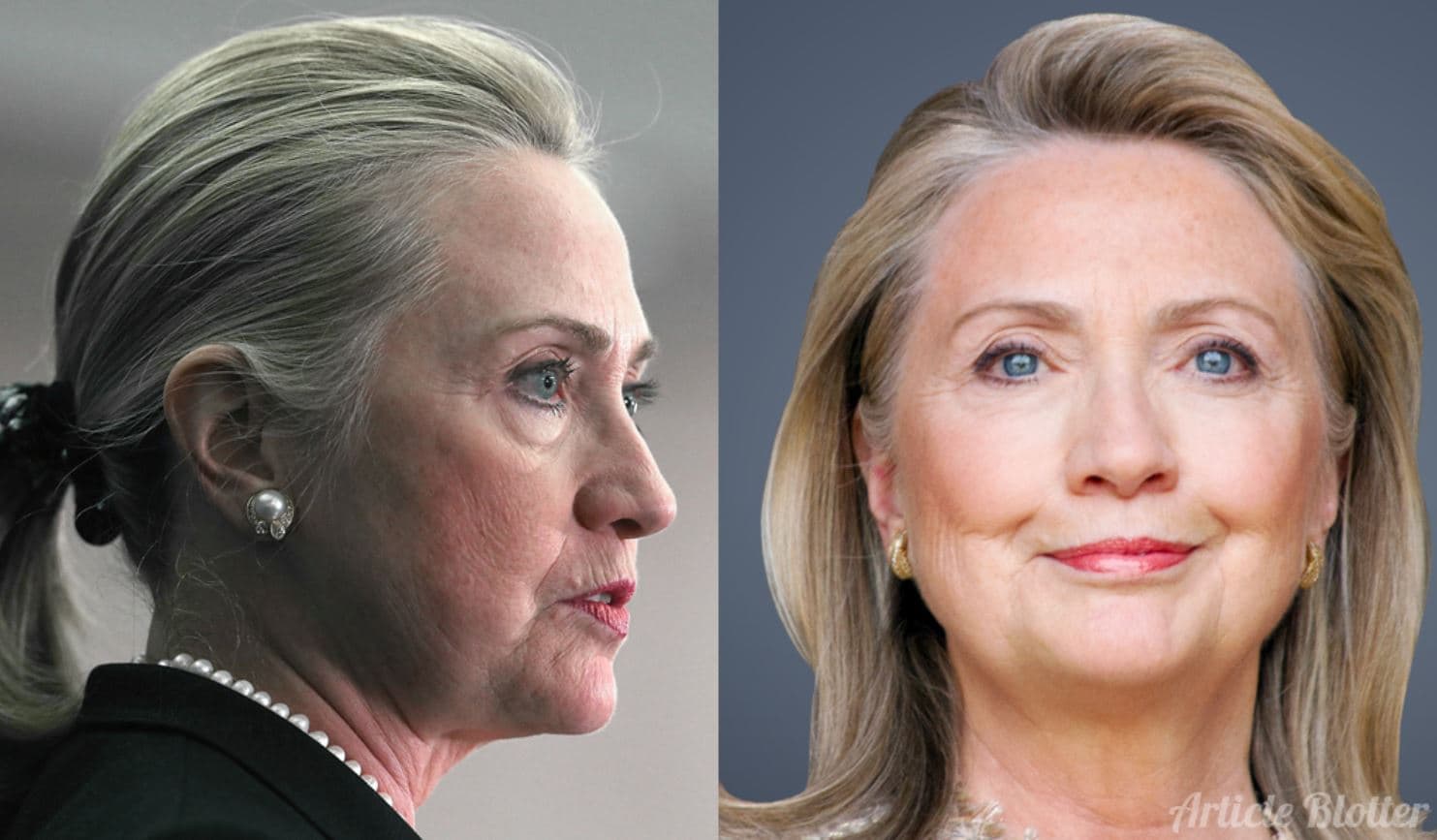 Hillary Cliton Before And After Plastic Surgery 1
