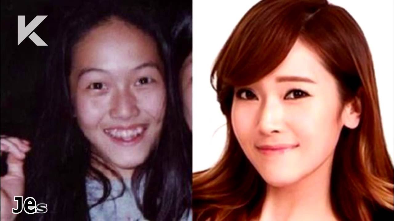 Idols Before And After Plastic Surgery 1