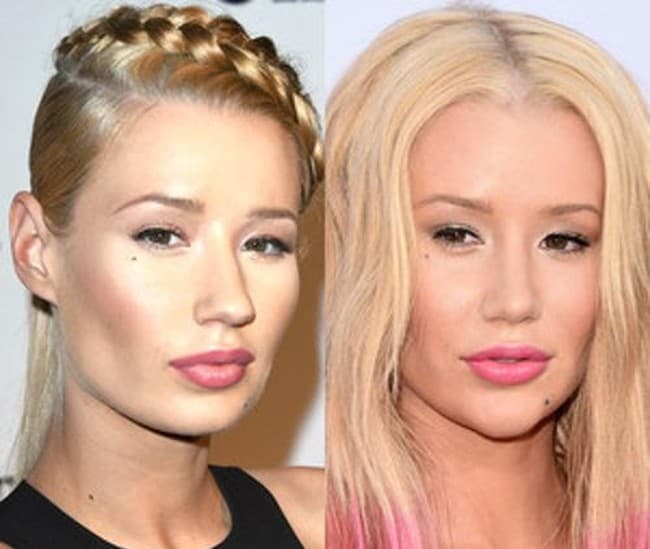 Iggy Azalea Plastic Surgery Face Before And After 2015 1