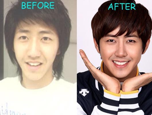 Kwang Hee Plastic Surgery Before 1