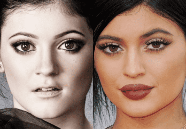 Kylie Kardashian Plastic Surgery Before And After 1