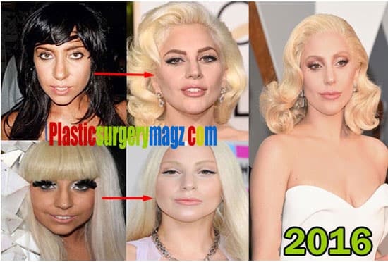 Lady Gaga Before And After Plastic Surgery Pictures 1