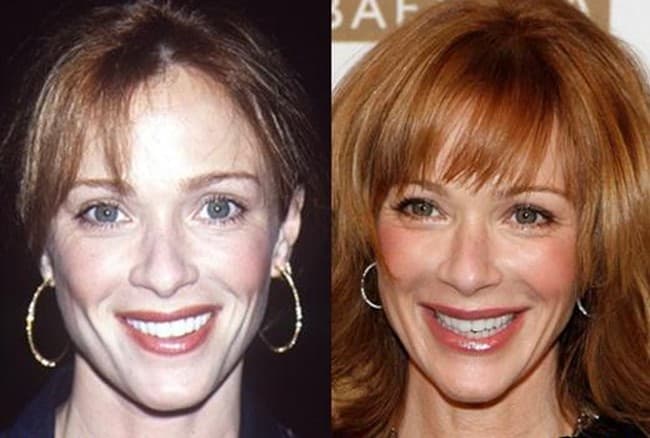 Lauren Holly Plastic Surgery Before And After Face 1