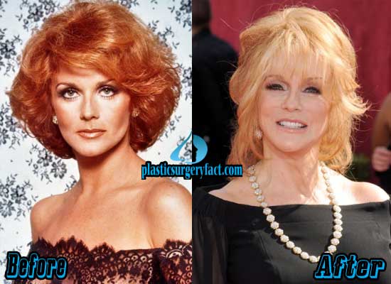 Lucille Ball Plastic Surgery Before And After 1