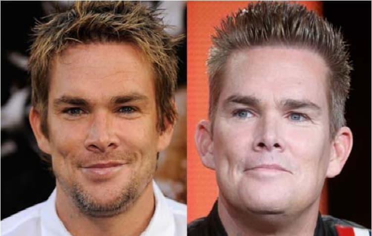 Male Celebrity Before And After Plastic Surgery Good 1