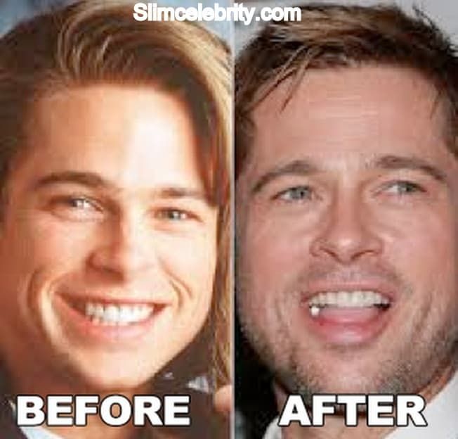 Photos Of Before And After Plastic Surgery Brad Pitt Teeth 1