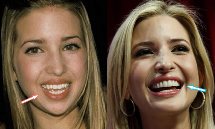 Pictures Of Before And After Plastic Surgery Ivanka Trump 1