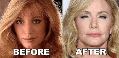 Shannon Tweed Before And After Plastic Surgery 1