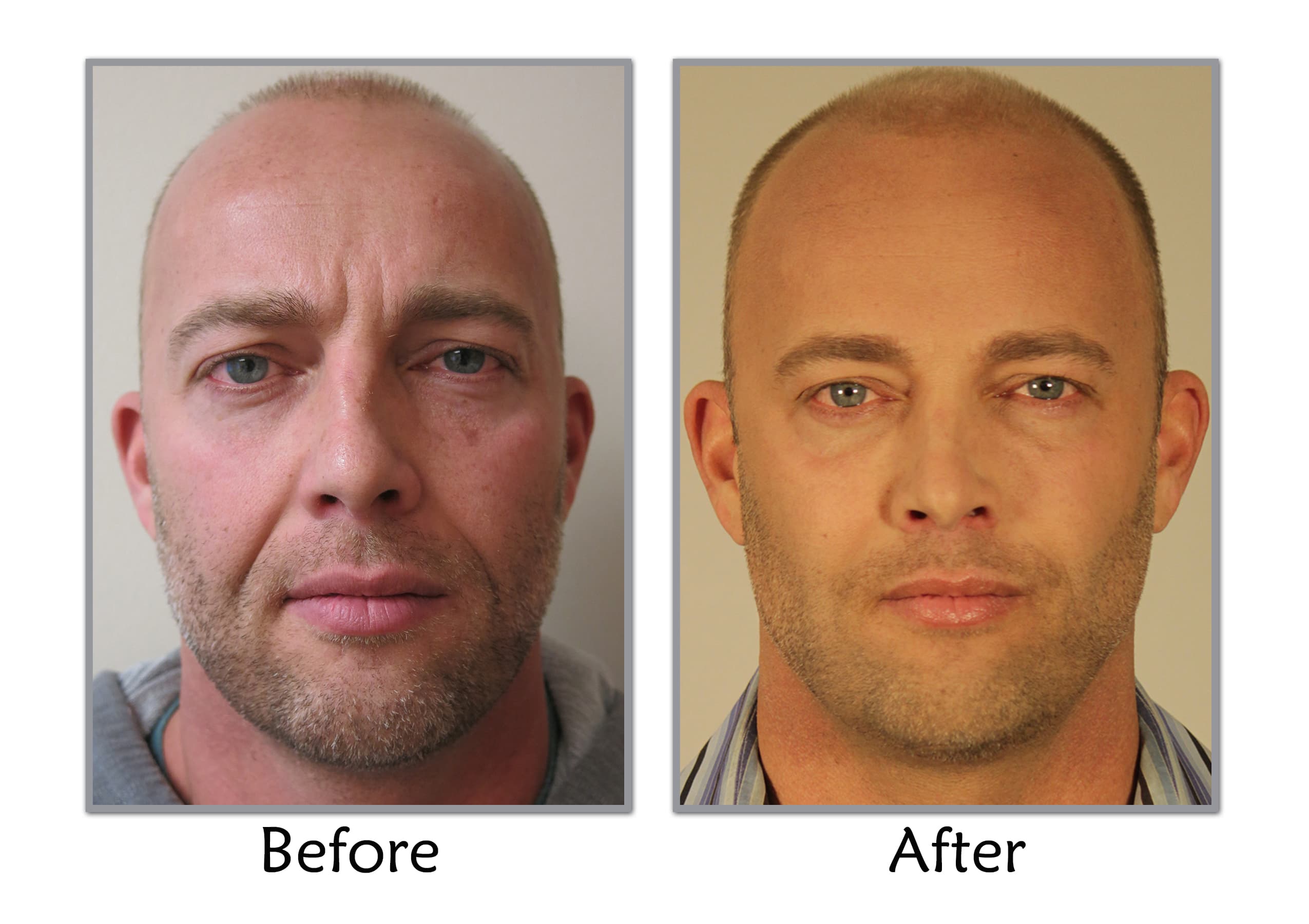The Facial Plastic Surgery For Men In Turkey Before And After Pictures 1