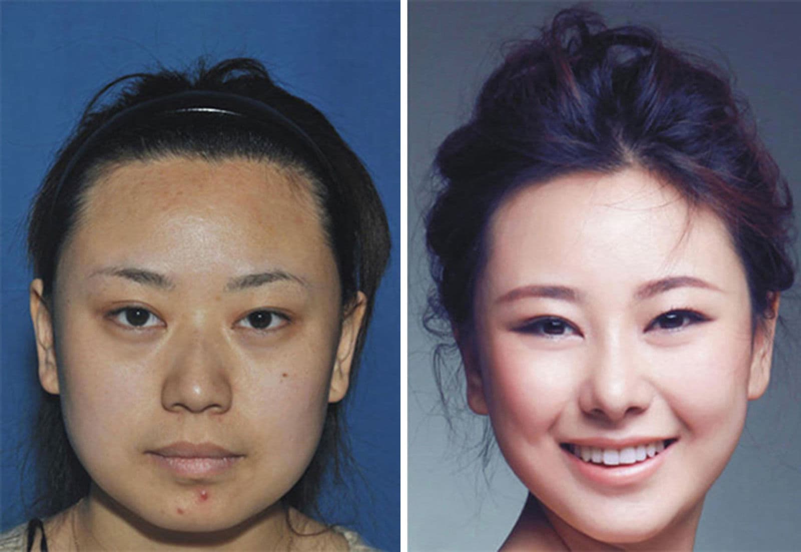 Asian Woman Plastic Surgery Before After 1
