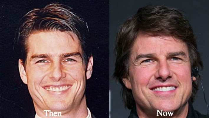 Cruise Plastic Surgery Before And After 1
