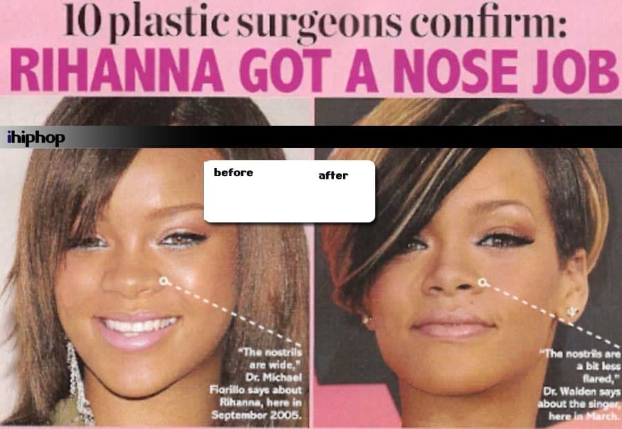 Drake Plastic Surgery Before And After 1