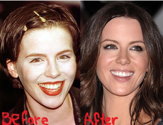 Kate Beckinsale Before And After Plastic Surgery 1
