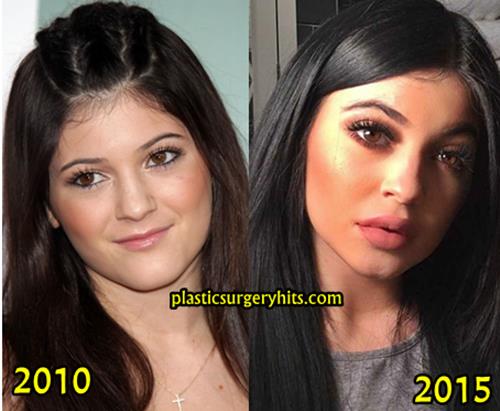 Kendall And Kylie Before Plastic Surgery 1
