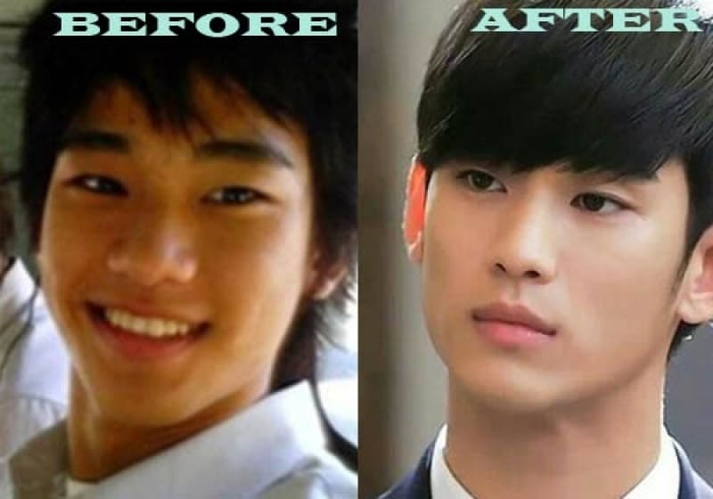 Kim Soo Hyun Plastic Surgery Before After 1