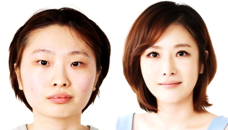 Korean Face Plastic Surgery Eyes Before And After 1