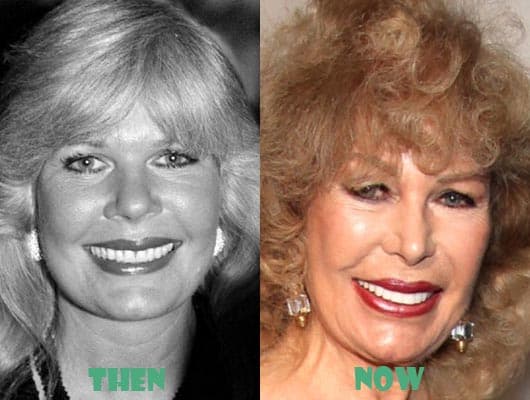 Loretta Swit Before And After Plastic Surgery 1