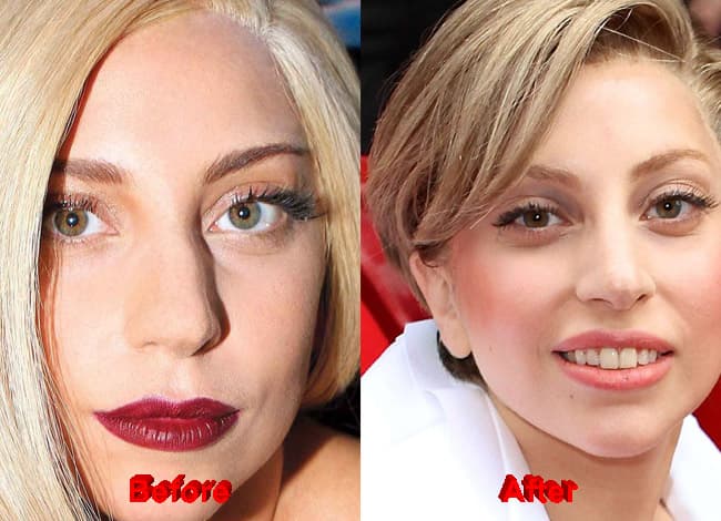 New Celebrity Plastic Surgery Before And After 1