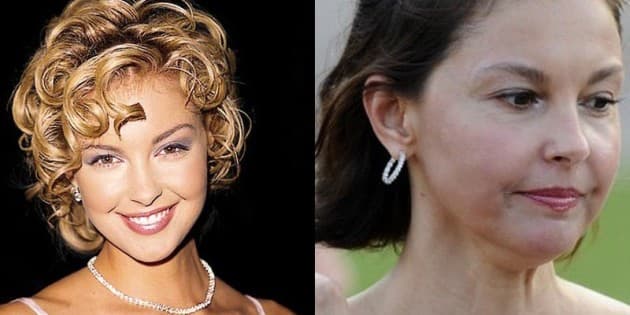 Plastic Surgery Before And After Photos Of Celebrities 1