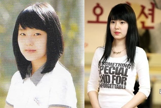 Plastic Surgery Irene Before After 1
