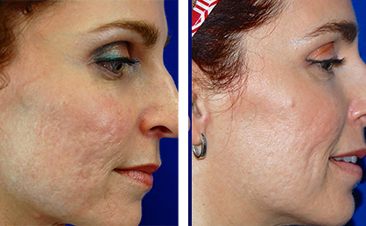 Acne Scar Plastic Surgery Before And After photo - 1