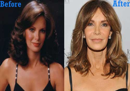 Actress Plastic Surgery Before After photo - 1