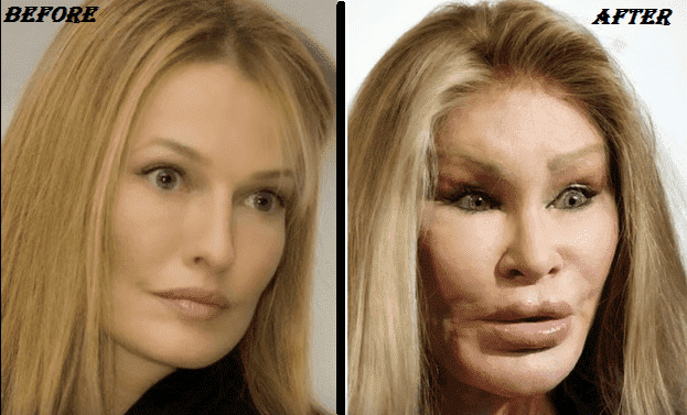 Bad Plastic Surgery Before After photo - 1