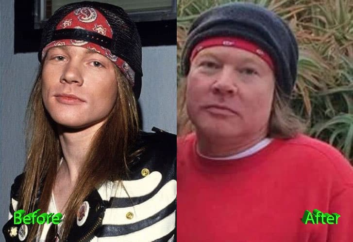 Bad Plastic Surgery Before And After Axl Rose photo - 1