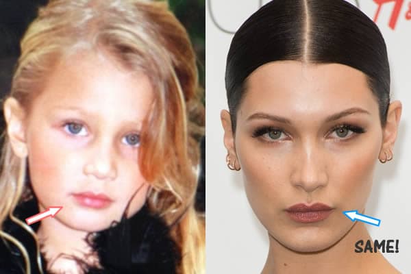 Before After Bellahadid Plastic Surgery photo - 1