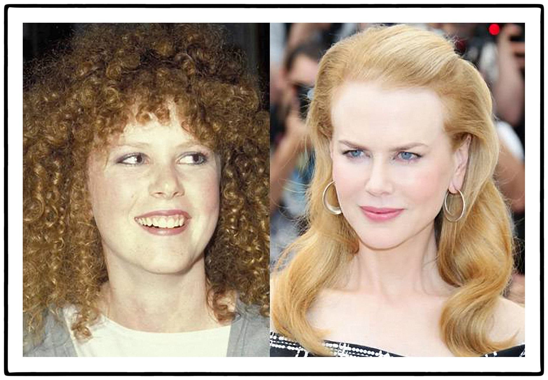 Before And After Plastic Surgery Nicole Kidman photo - 1