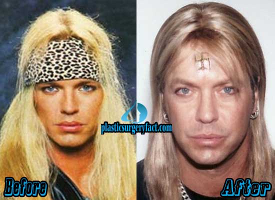 Bret Michaels Plastic Surgery Before And After photo - 1
