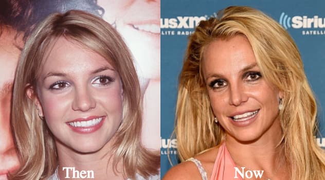 Brittany Spears Before And After Plastic Surgery photo - 1