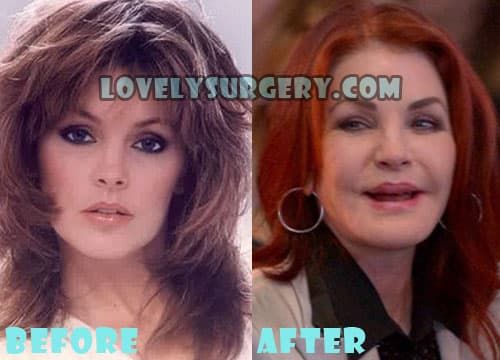 Elvis Plastic Surgery Before And After Photos photo - 1