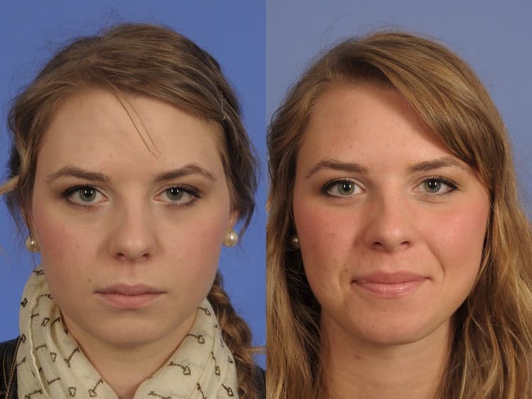 Eyelid Plastic Surgery Before And After Heavy Eye Lids photo - 1