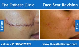 Face Plastic Surgery Before And After In India photo - 1