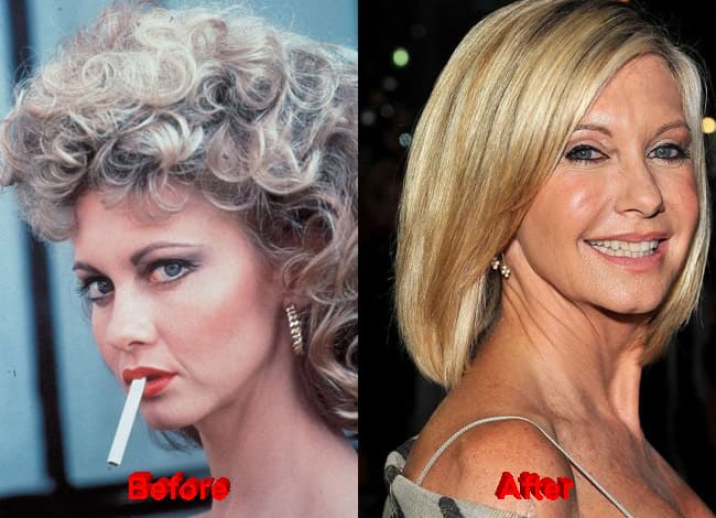 Famous Before And After Plastic Surgery photo - 1