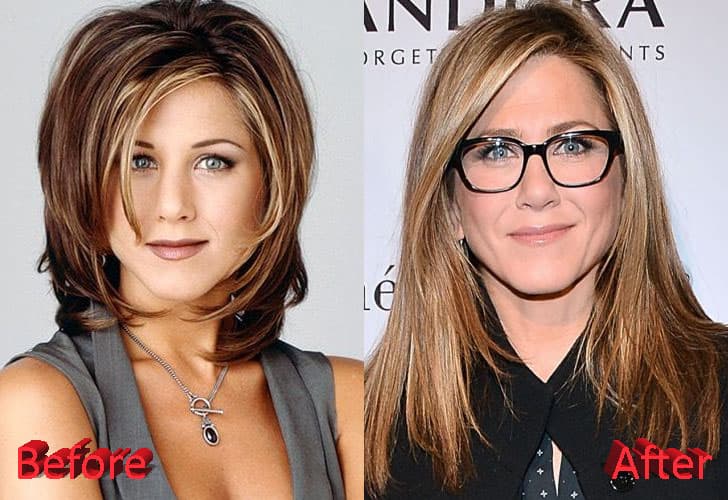 Jenifer Aniston Before And After Plastic Surgery photo - 1