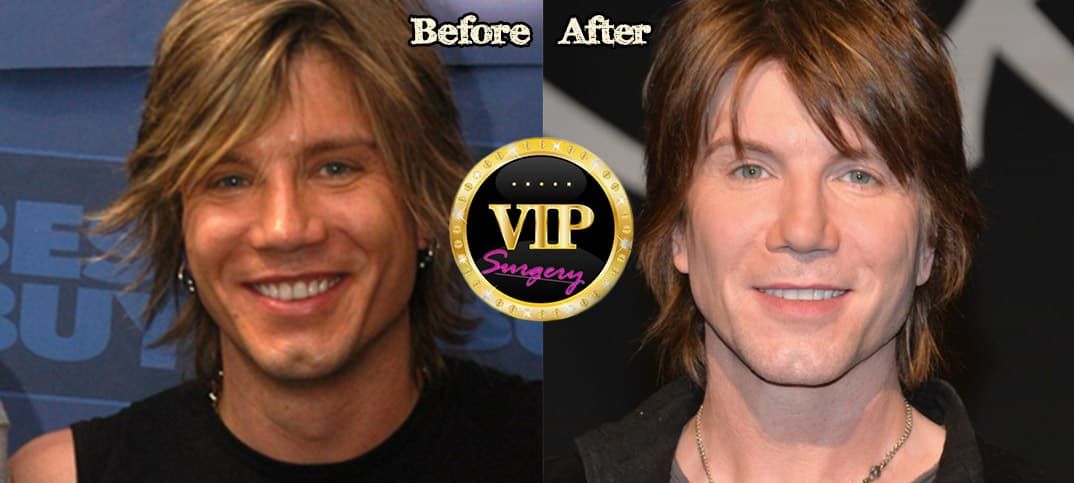 John Rzeznik Plastic Surgery Before And After photo - 1