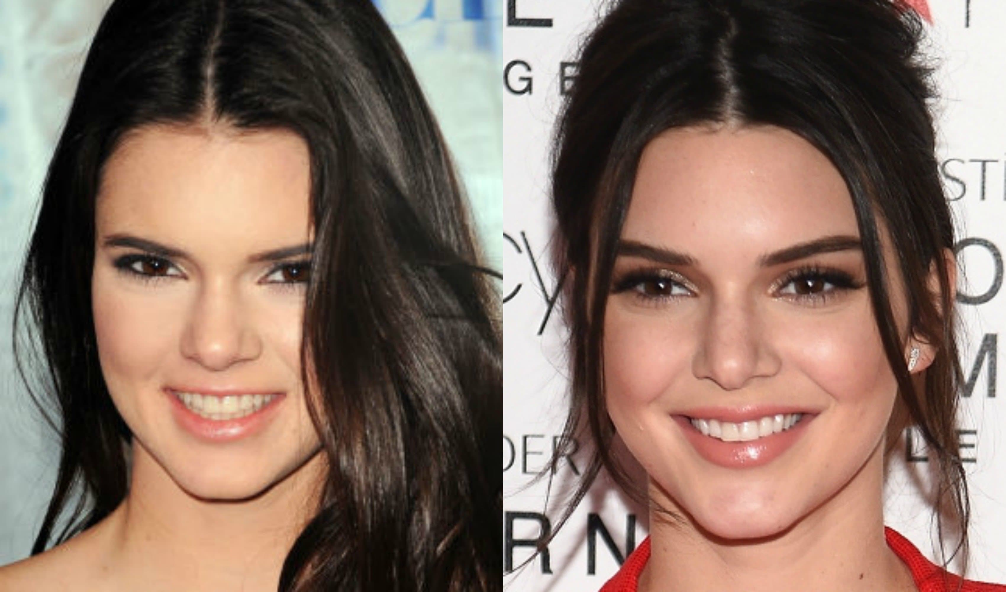 Kendall Jenner Before Plastic Surgery Before And After photo - 1