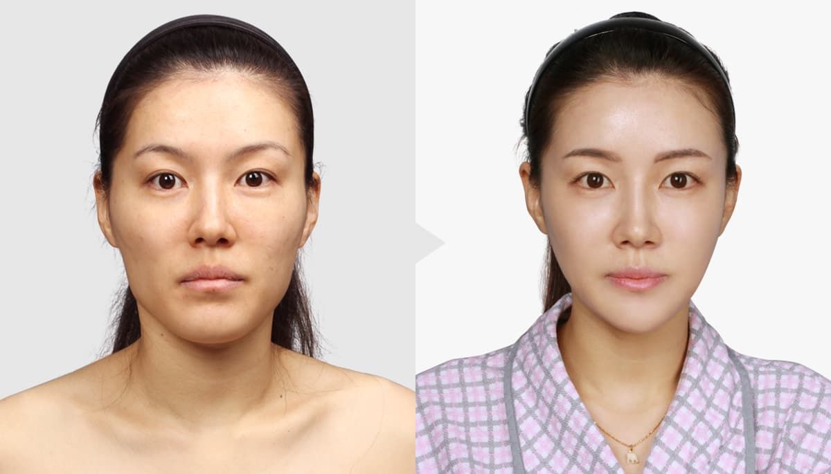 Korean Celebrities Before And After Plastic Surgery photo - 1
