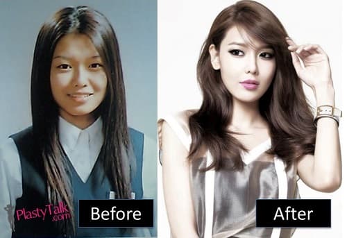 Kpop Idols Plastic Surgery Before And After photo - 1