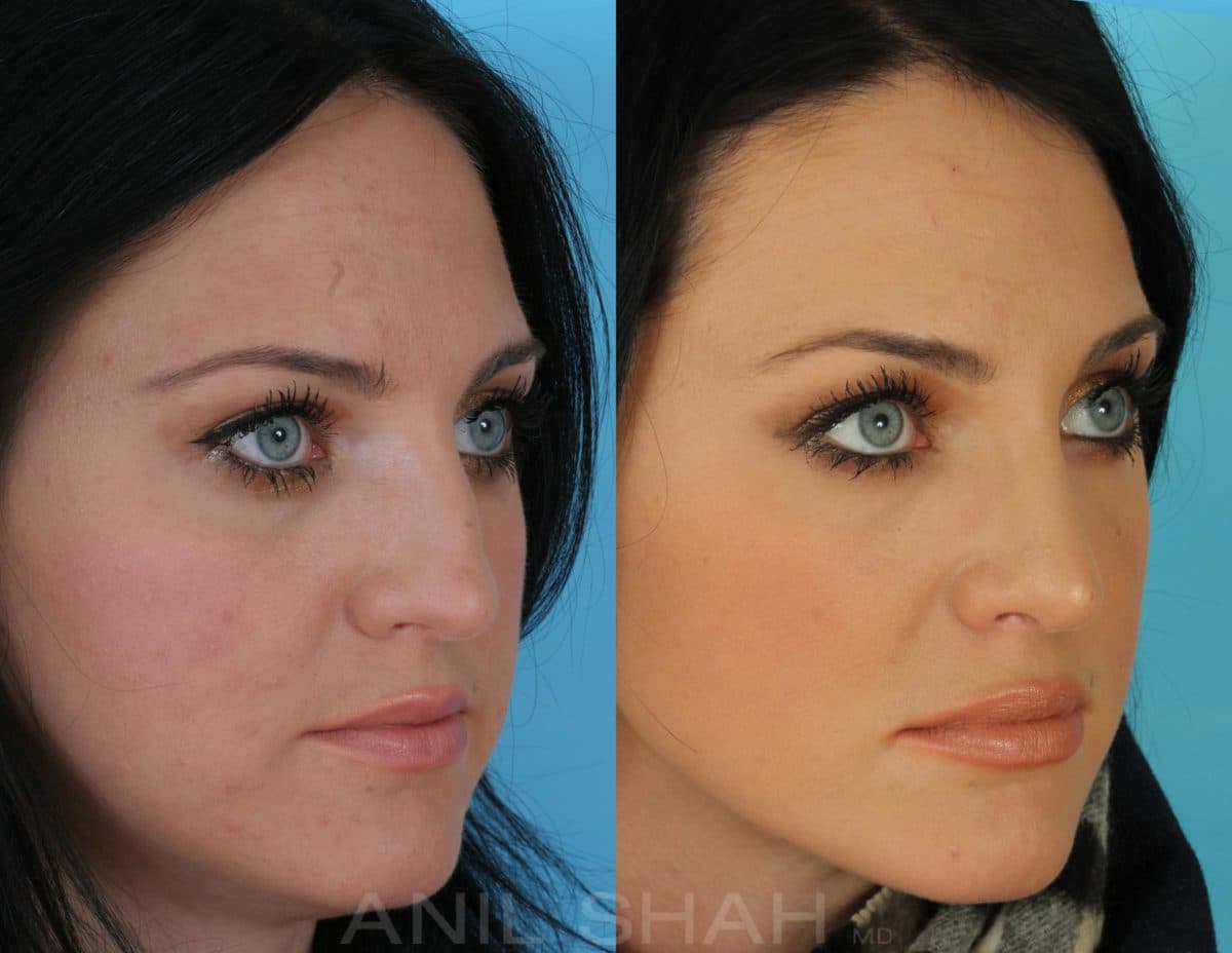 Plastic Surgery Facial Scars Before And After photo - 1
