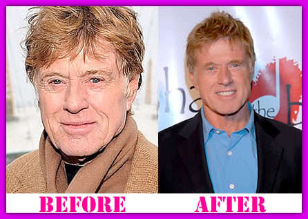 Robert Redford Before And After Plastic Surgery photo - 1