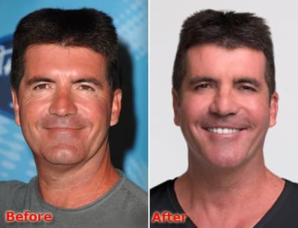 Simon Cowell Before And After Plastic Surgery photo - 1