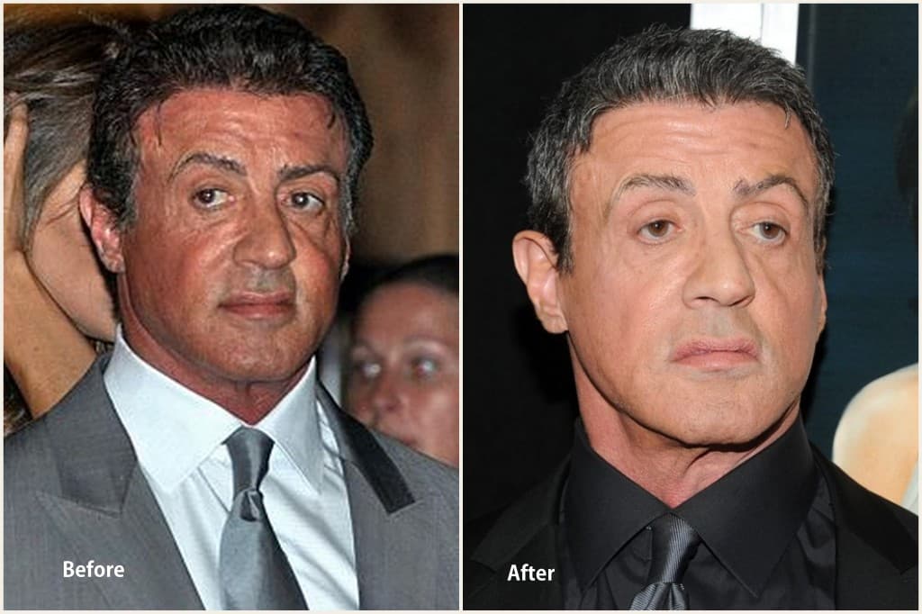 Sylvester Stallone Before Plastic Surgery photo - 1