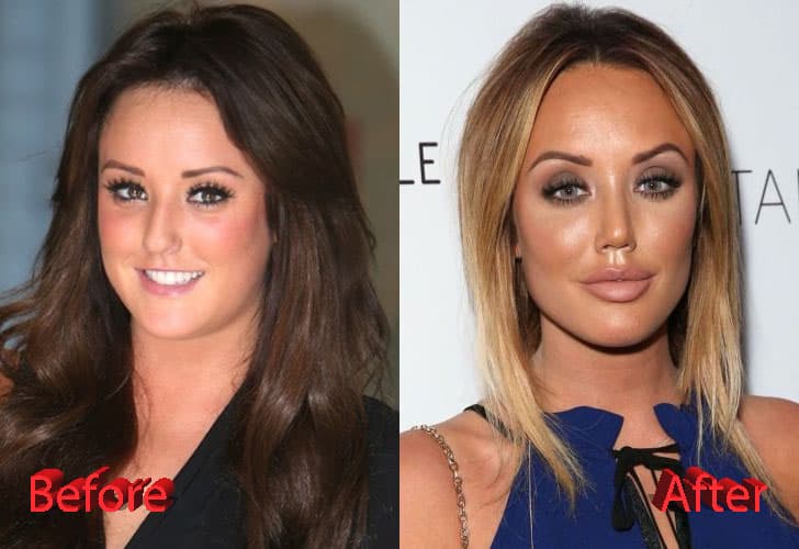 Vicky Pattison Plastic Surgery Before And After photo - 1