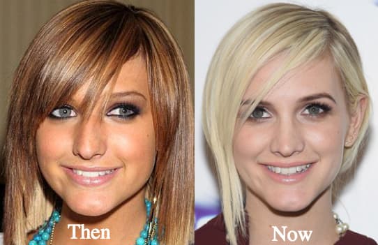 Ashlee Simpson Before And After Plastic Surgery 1