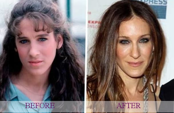 Celebrity Plastic Surgery Before After 1