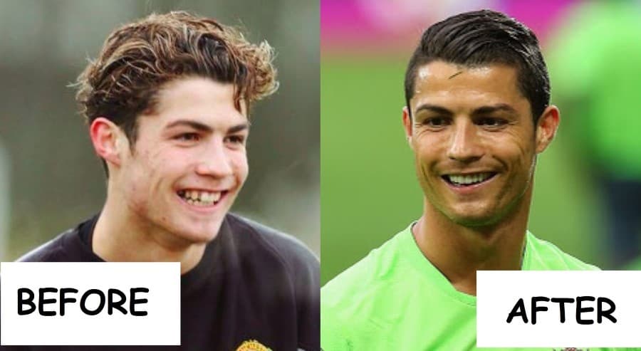 Cristiano Ronaldo Plastic Surgery Before And After 1