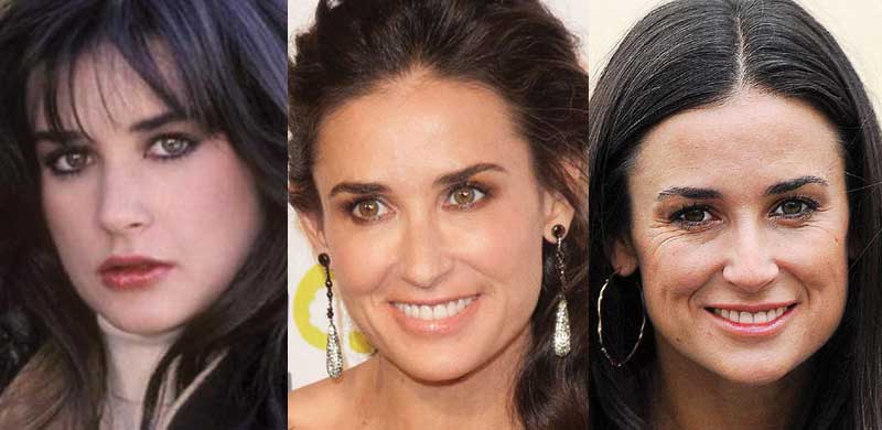 Demi Moore Plastic Surgery Before And After 1